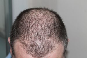 Causes of Hair Loss
